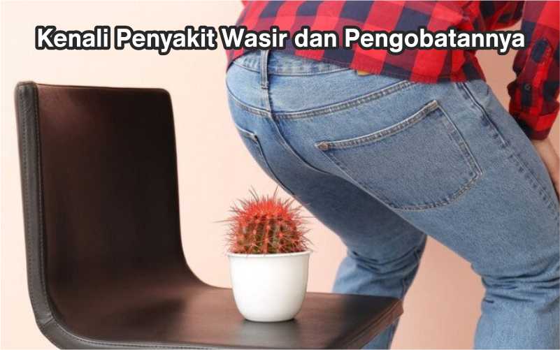Kenali Penyakit Wasir dan Pengobatannya 1 Penyakit wasir dan pengobatan wasir