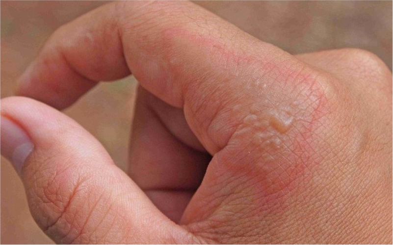 gejala impetigo pada kulit
